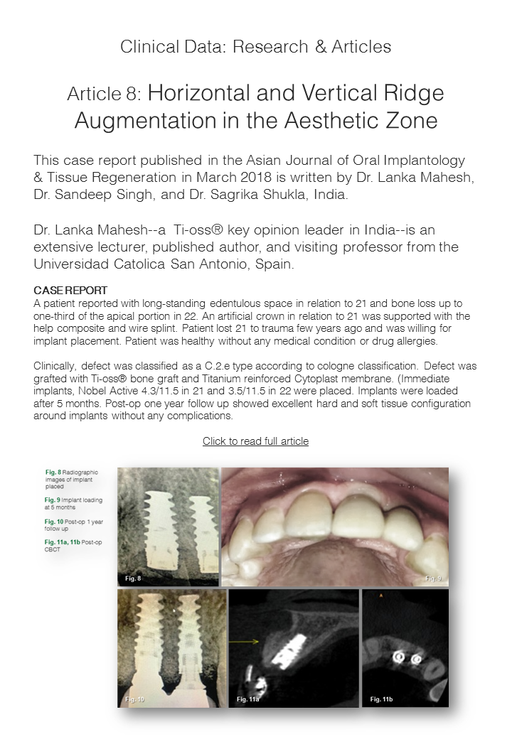 Ti-oss Horizontal and Vertical Ridge Augmentation in the Aesthetic Zone